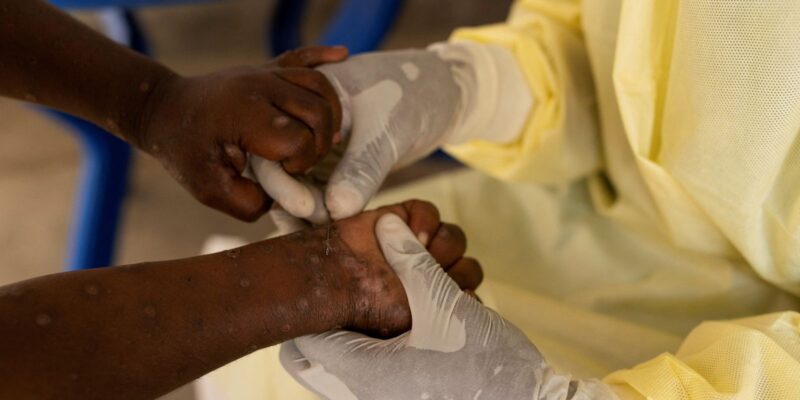 Agência da ONU para migrações pede US$ 18,5 bi para combater mpox