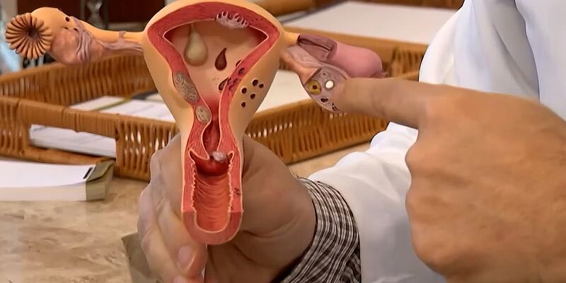 Endometriose: conheça os sintomas e saiba como tratar a doença