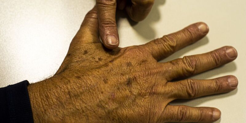 Desinformação sobre câncer de pele afeta diagnóstico, diz instituição