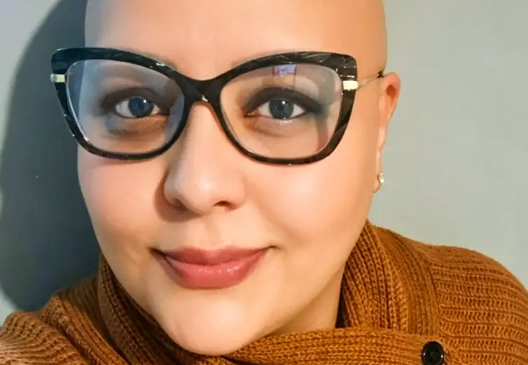 Brasília - DF - A alopecia areata é uma doença autoimune, caracterizada pelo ataque ao folículo piloso. ( Juliana Fernandes convive com a alopecia areata universal há mais de 20 anos). Foto: arquivo pessoal
